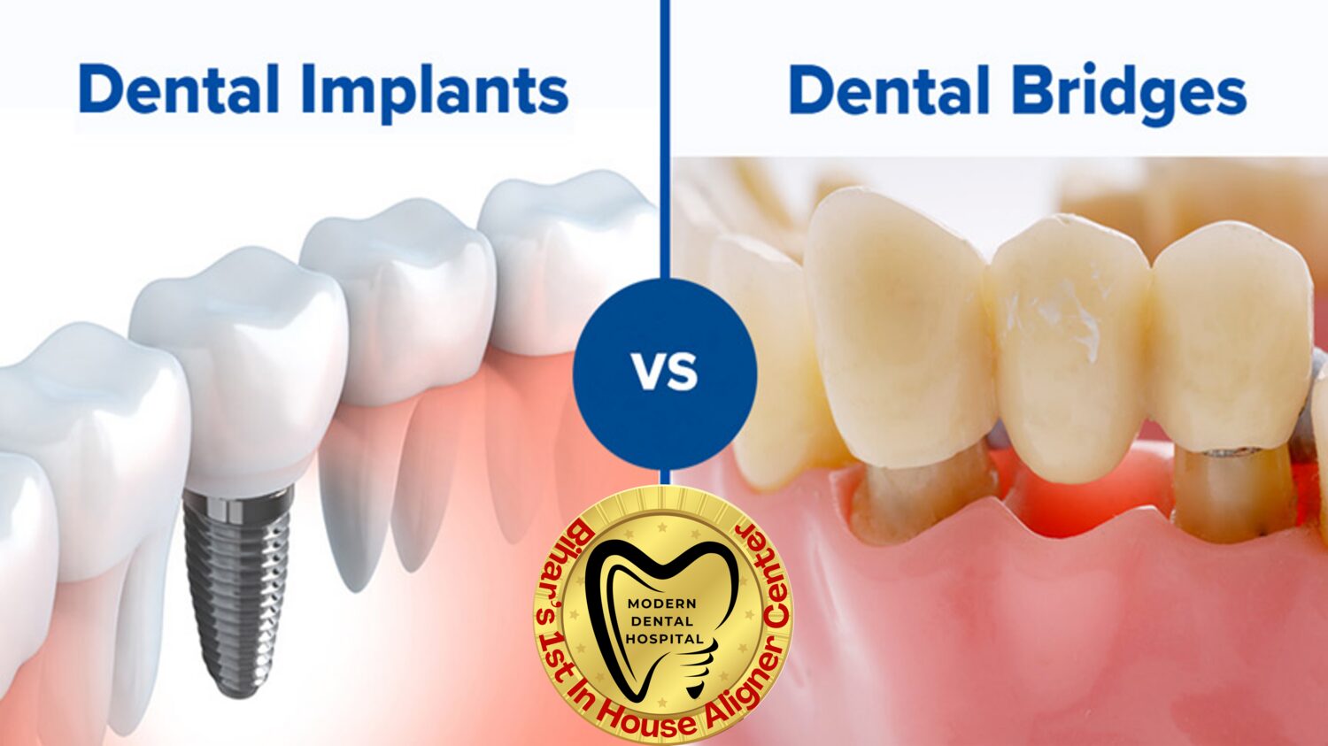 Dental implants vs dental bridges comparison, Modern Dental Hospital Patna