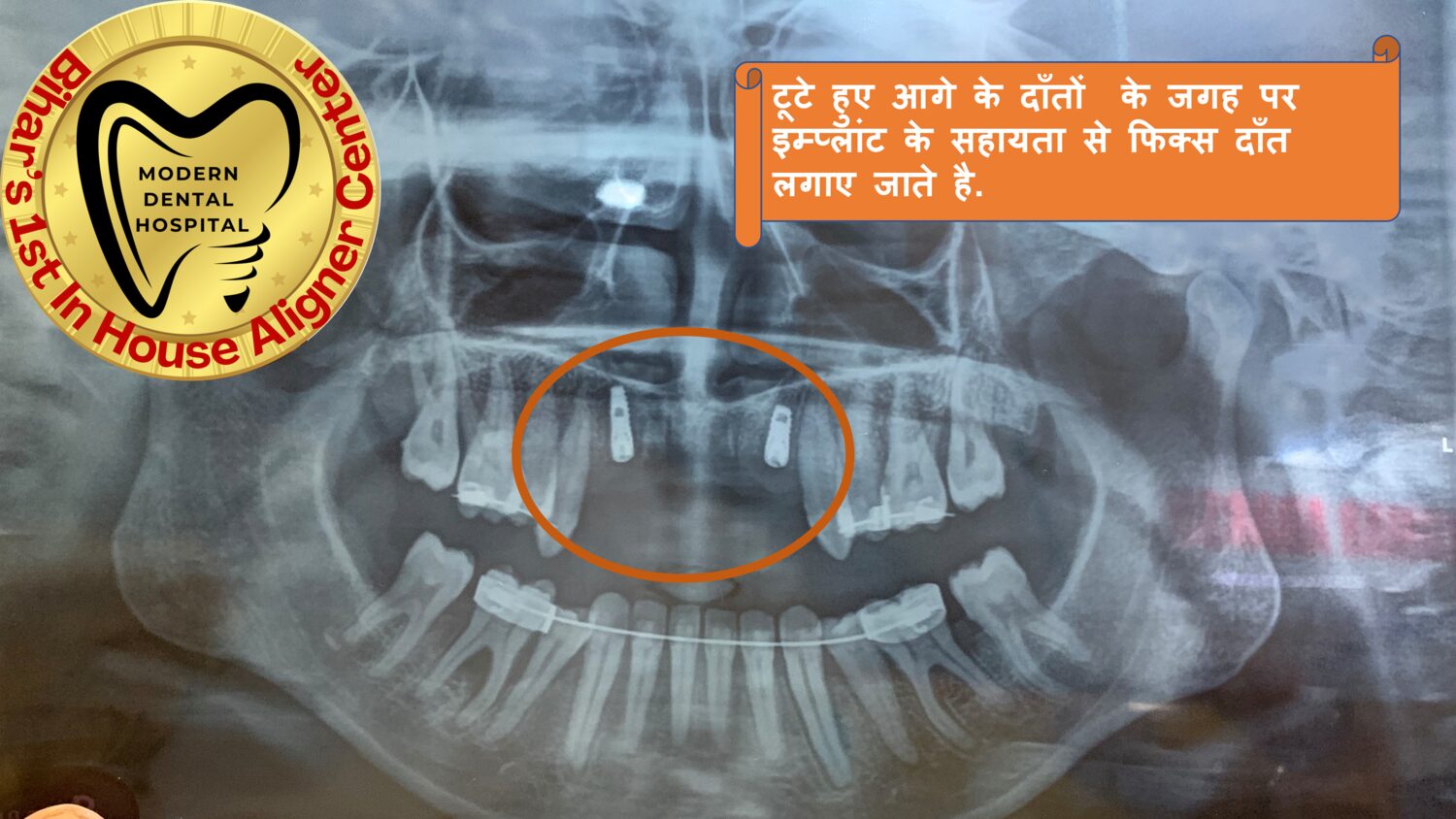 Front teeth dental implant X-ray Patna