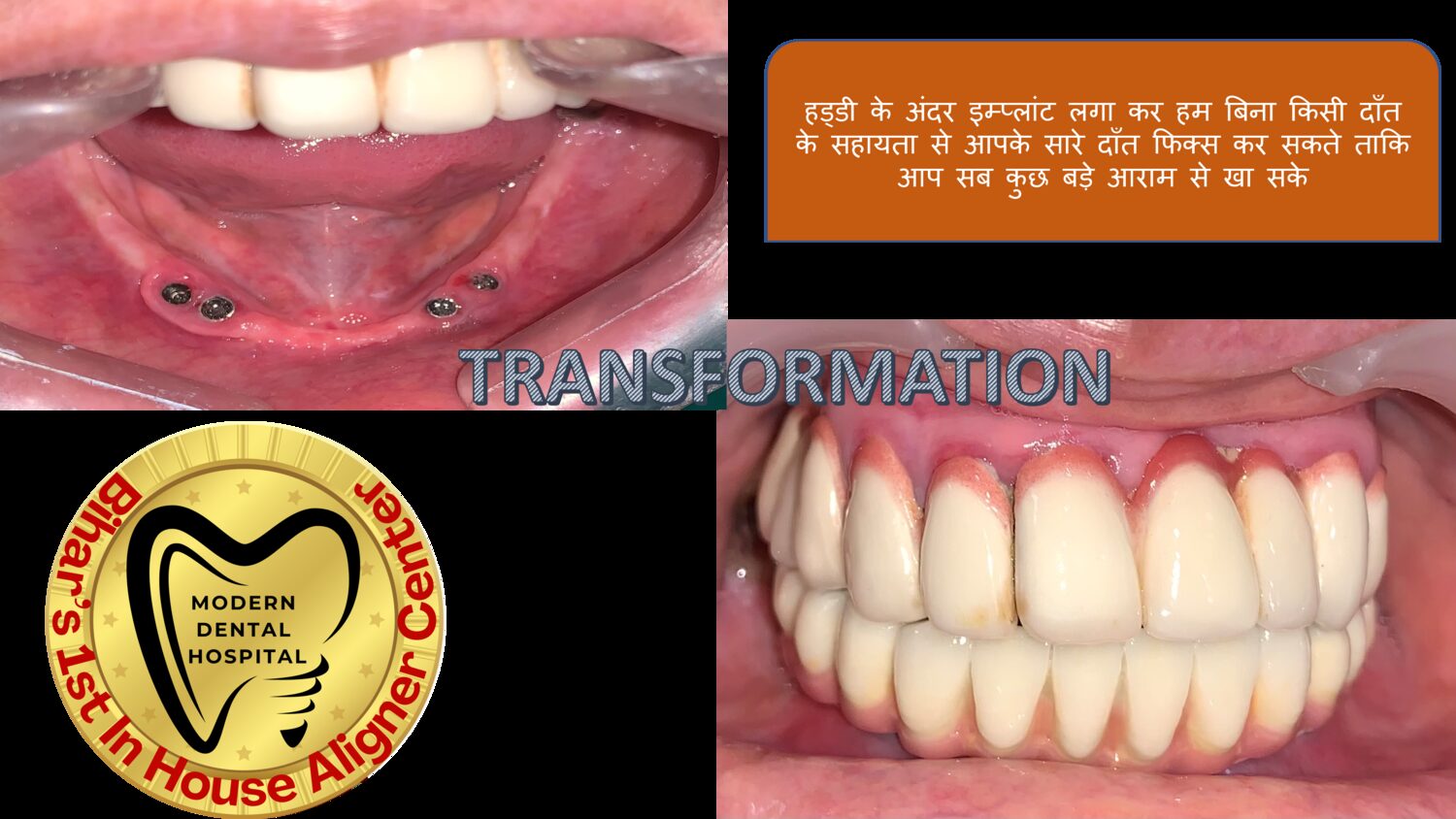 Full mouth dental implant transformation before and after in Patna